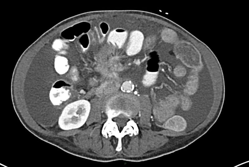 File:Carcinoid mesenteric tumor complicated by chylous ascites (Radiopaedia 76312-87953 A 40).jpg