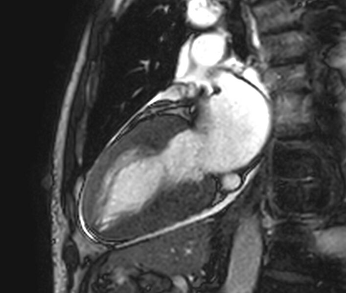 File:Cardiac amyloidosis (Radiopaedia 39736-42124 B 20).jpg