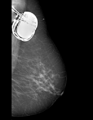 Cardiac pacemaker (mammography) (Radiopaedia 72298-82831 L MLO 1).PNG
