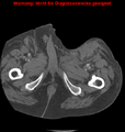 Cardiac perforation following transcatheter aortic valve implantation (Radiopaedia 23714-23863 B 20).png