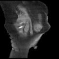 Cardiogenic pulmonary edema (Radiopaedia 29213-29609 Coronal non-contrast 43).jpg