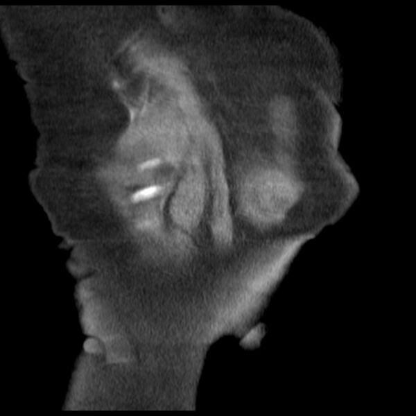 File:Cardiogenic pulmonary edema (Radiopaedia 29213-29609 Coronal non-contrast 43).jpg