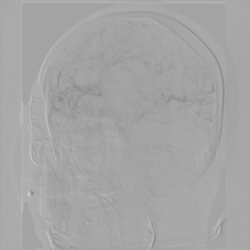 Caroticocavernous fistula - direct (Radiopaedia 61660-69666 Oblique Left ICA 29).jpg