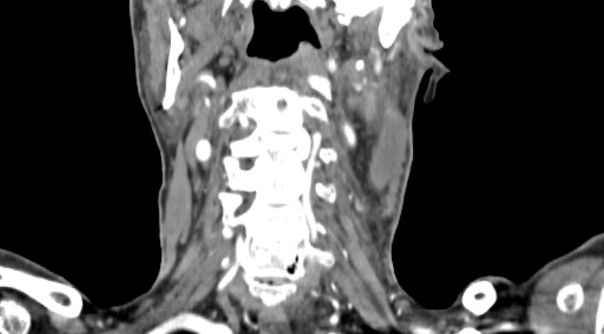 Carotid artery pseudoaneurysm (Radiopaedia 84030-99259 D 56).jpg