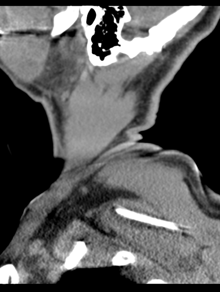 File:Cavernoma of cervical cord (Radiopaedia 50838-56346 B 2).png