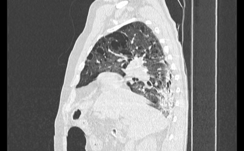 File:Cavitating bronchogenic carcinoma (Radiopaedia 44489-48162 Sagittal lung window 17).jpg