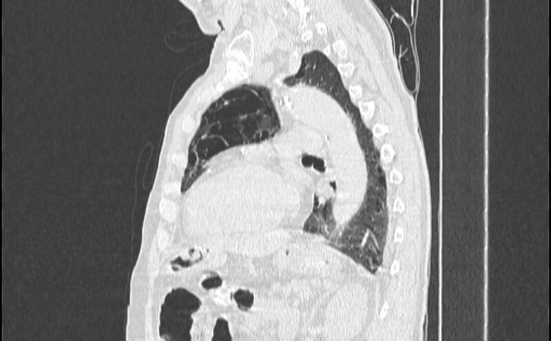 File:Cavitating bronchogenic carcinoma (Radiopaedia 44489-48162 Sagittal lung window 41).jpg