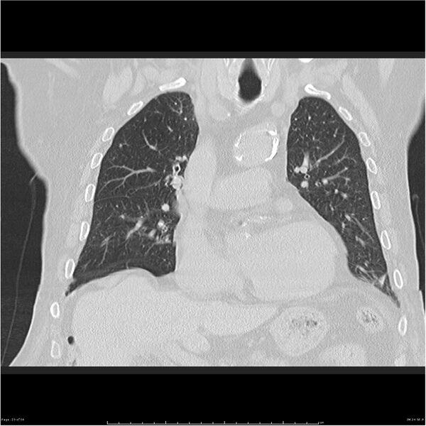 File:Cavitating left lower lobe lesion - squamous cell lung cancer (Radiopaedia 27749-28176 Coronal lung window 23).jpg