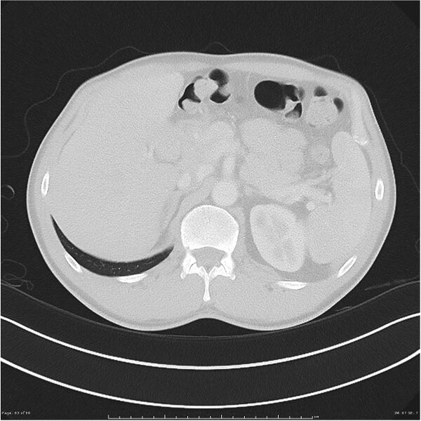 File:Cavitating lung cancer (Radiopaedia 25796-25945 Axial lung window 63).jpg