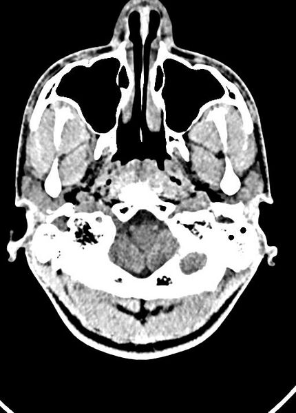 File:Cavum septum pellucidum and cavum vergae (Radiopaedia 77797-90060 Axial Brain Window 12).jpg