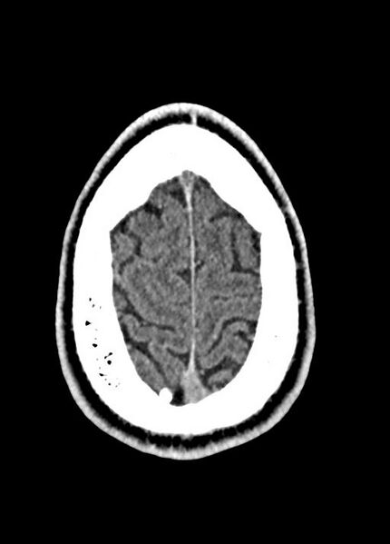 File:Cavum septum pellucidum and cavum vergae (Radiopaedia 77797-90060 Axial Brain Window 93).jpg