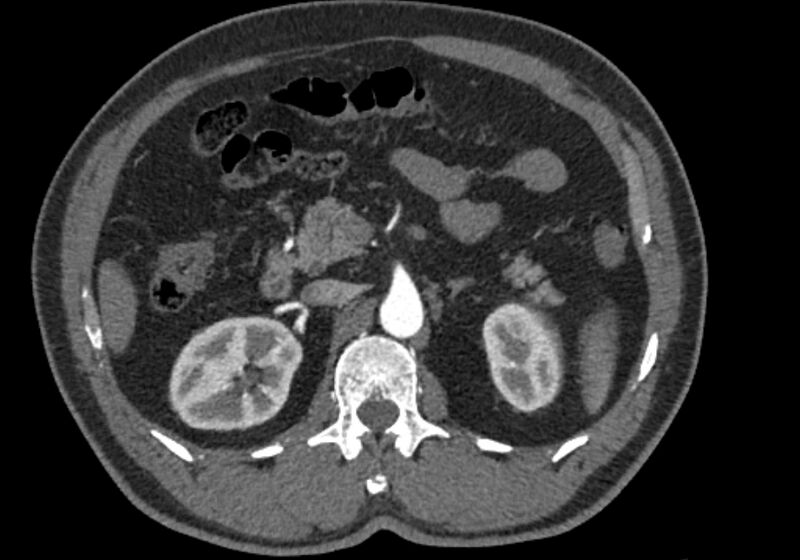 File:Celiac artery dissection (Radiopaedia 52194-58080 A 36).jpg