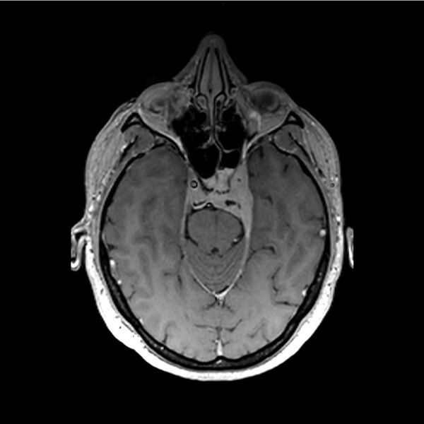 File:Central base of skull meningioma (Radiopaedia 53531-59549 Axial T1 C+ 16).jpg