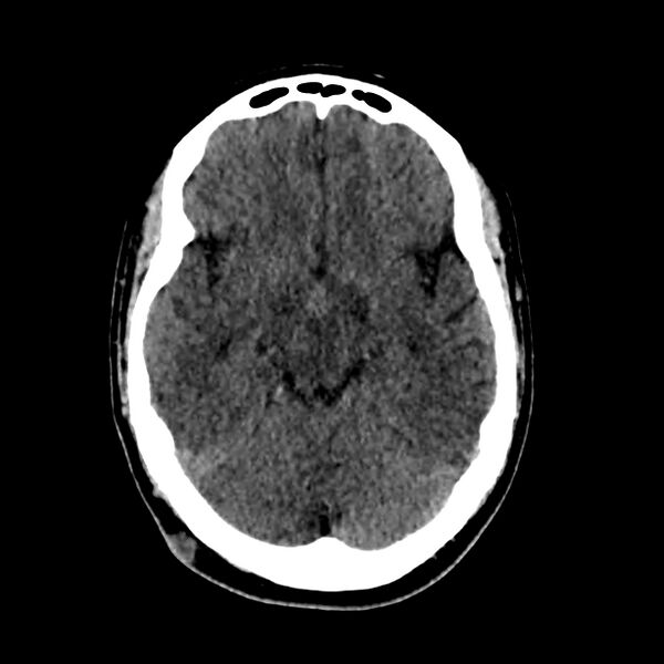 File:Central nervous system Langerhans cell histiocytosis (Radiopaedia 65728-74878 Axial non-contrast 22).jpg