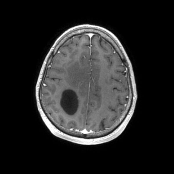 File:Central neurocytoma (Radiopaedia 67618-77021 Axial T1 C+ 23).jpg