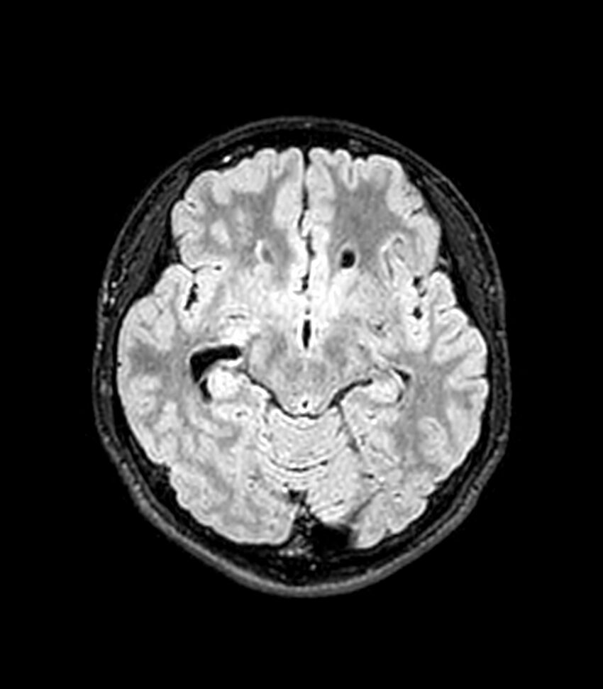 Central neurocytoma (Radiopaedia 79320-92380 Axial FLAIR 185).jpg