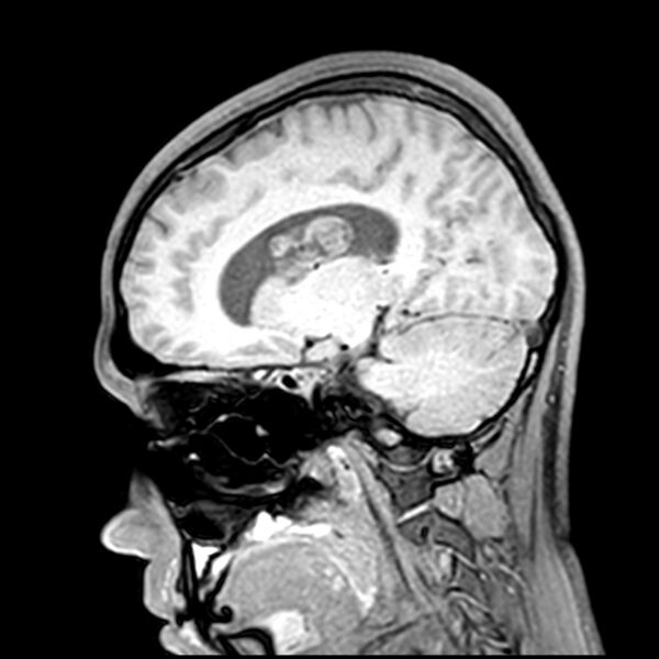 File:Central neurocytoma (Radiopaedia 79320-92380 Sagittal T1 107).jpg