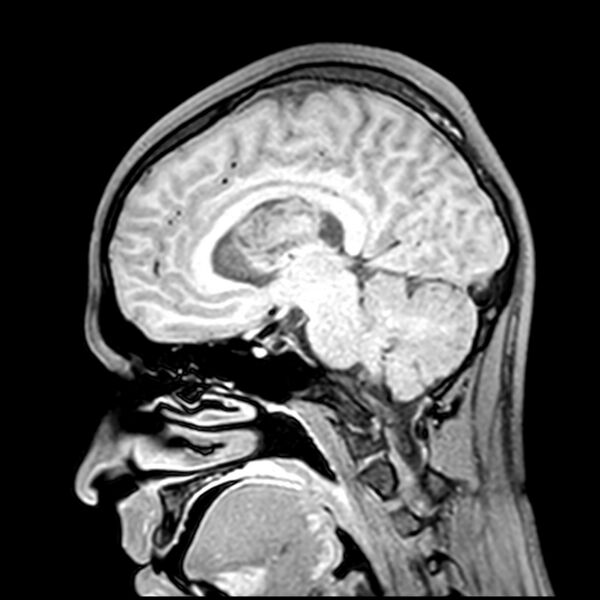 File:Central neurocytoma (Radiopaedia 79320-92380 Sagittal T1 119).jpg