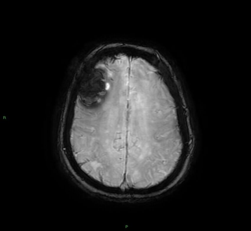 Cerebral amyloid angiopathy-associated lobar intracerebral hemorrhage (Radiopaedia 58378-65517 Axial SWI 55).jpg