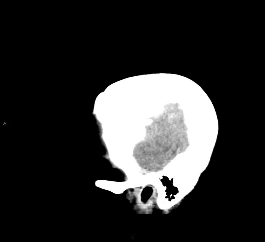 Cerebral amyloid angiopathy-associated lobar intracerebral hemorrhage (Radiopaedia 58379-65519 C 6).jpg