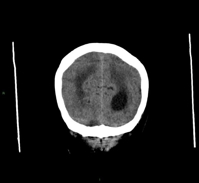 File:Cerebral amyloid angiopathy-associated lobar intracerebral hemorrhage (Radiopaedia 58560-65723 Coronal non-contrast 14).jpg