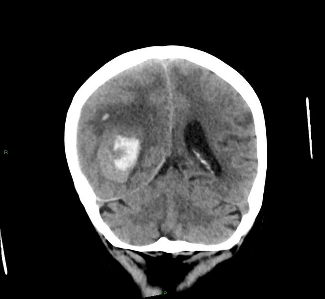 File:Cerebral amyloid angiopathy-associated lobar intracerebral hemorrhage (Radiopaedia 58563-65727 Coronal non-contrast 24).jpg