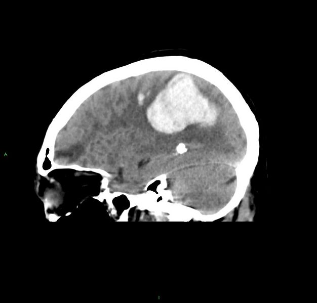 File:Cerebral amyloid angiopathy-associated lobar intracerebral hemorrhage (Radiopaedia 59356-66716 C 19).jpg