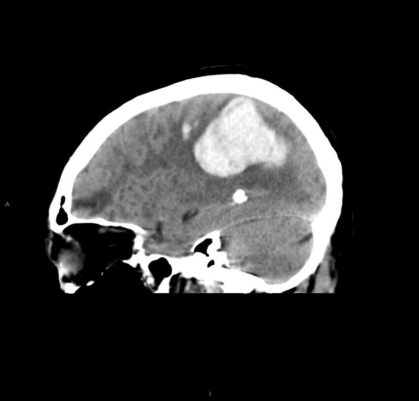 Cerebral amyloid angiopathy-associated lobar intracerebral hemorrhage (Radiopaedia 59356-66716 C 19).jpg