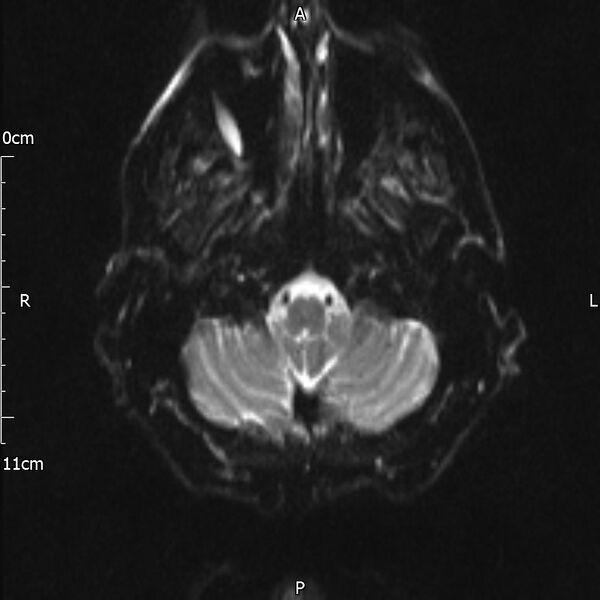 File:Cerebral amyloid angiopathy related inflammation (Radiopaedia 72772-83415 Axial DWI 4).jpg