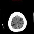 Cerebral and orbital tuberculomas (Radiopaedia 13308-13310 Axial non-contrast 25).jpg
