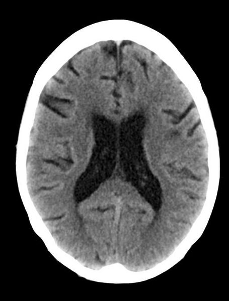 File:Cerebral aneurysm with rupture (Radiopaedia 29933-30457 Axial non-contrast 15).jpg
