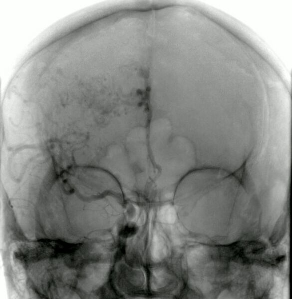 File:Cerebral arteriovenous malformation (Radiopaedia 10989-11408 E 1).jpg