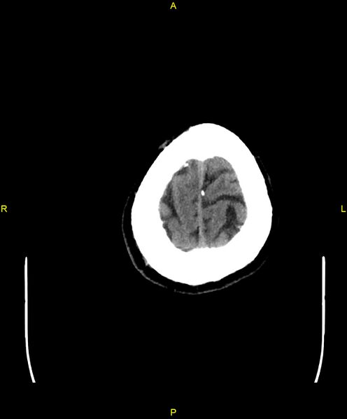 File:Cerebral autosomal dominant arteriopathy with subcortical infarcts and leukoencephalopathy (CADASIL) (Radiopaedia 86108-102051 Axial non-contrast 107).jpg
