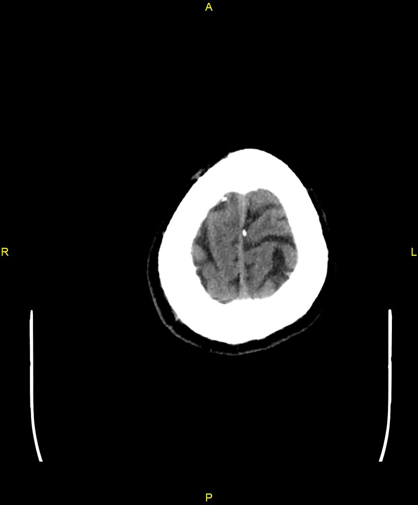 Cerebral autosomal dominant arteriopathy with subcortical infarcts and leukoencephalopathy (CADASIL) (Radiopaedia 86108-102051 Axial non-contrast 107).jpg