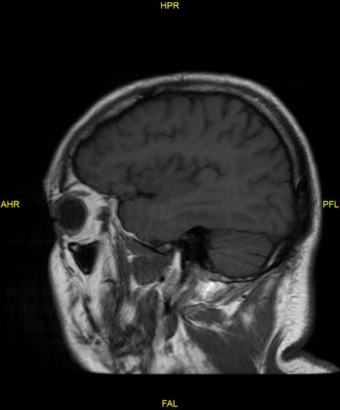 File:Cerebral autosomal dominant arteriopathy with subcortical infarcts and leukoencephalopathy (CADASIL) (Radiopaedia 86108-102054 Sagittal T1 21).jpg