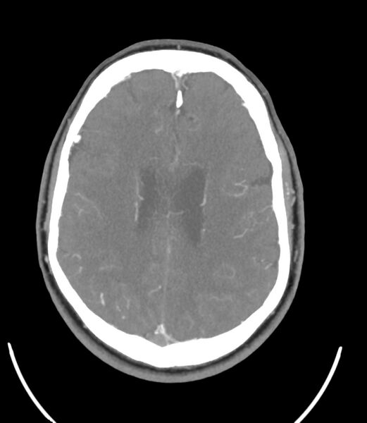 File:Cerebral dural venous sinus thrombosis (Radiopaedia 86514-102576 A 67).jpg
