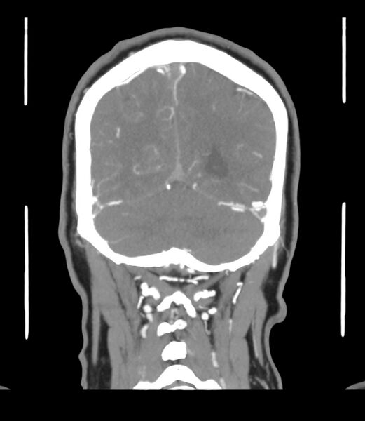 File:Cerebral dural venous sinus thrombosis (Radiopaedia 86514-102576 B 59).jpg