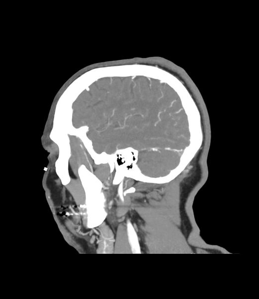 File:Cerebral dural venous sinus thrombosis (Radiopaedia 86514-102576 C 7).jpg