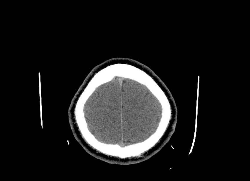 Cerebral edema (Radiopaedia 82519-96661 Axial non-contrast 9).jpg
