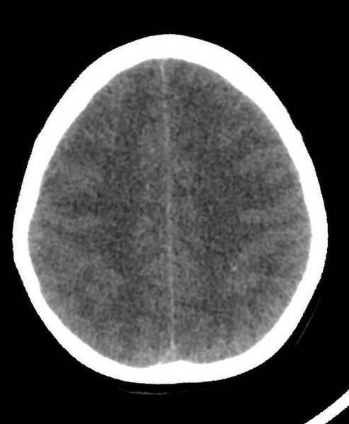 File:Cerebral edema due to severe hyponatremia (Radiopaedia 89826-106937 Axial non-contrast 66).jpg