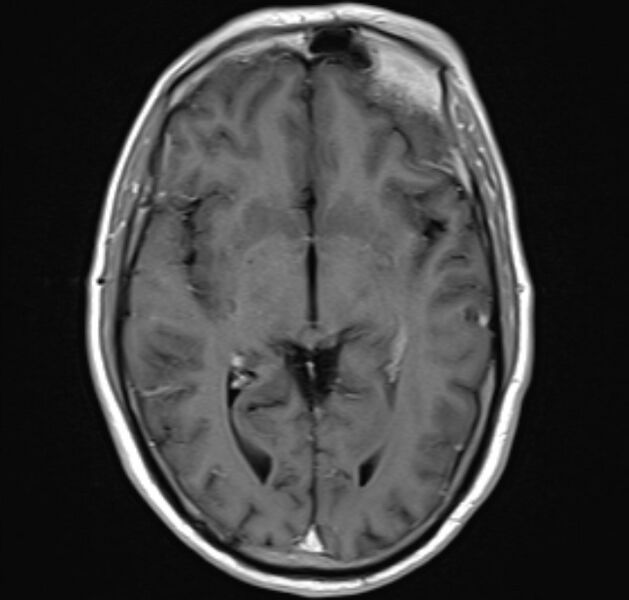 File:Cerebral venous thrombosis (Radiopaedia 71207-81504 Axial T1 C+ 12).jpg