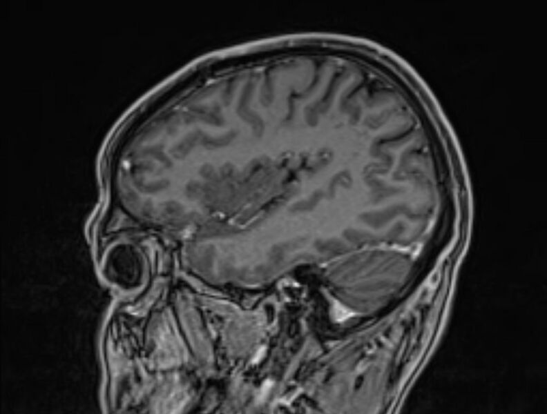 File:Cerebral venous thrombosis (Radiopaedia 71207-81504 Sagittal T1 C+ 49).jpg