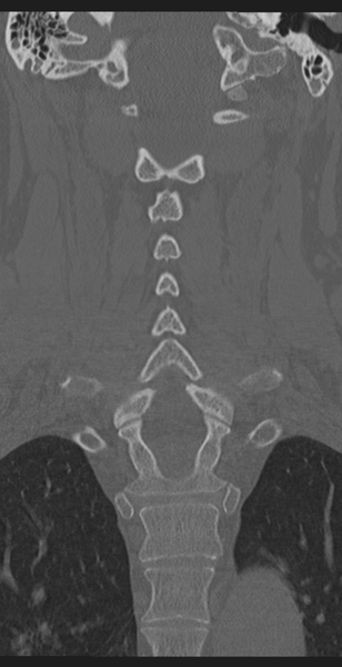 File:Cervical canal stenosis - OPLL and osteophytes (Radiopaedia 47329-51910 Coronal bone window 36).png