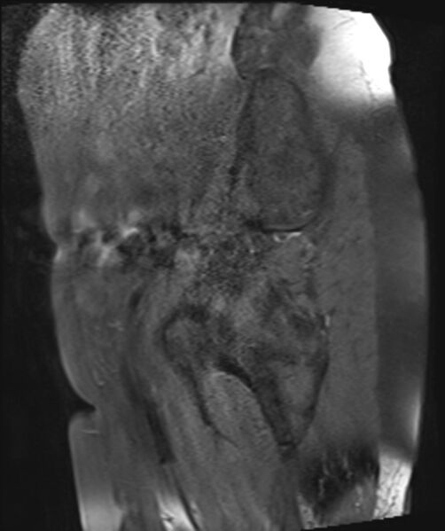 File:Cervical carcinoma (Radiopaedia 88312-104943 Sagittal T1 fat sat 6).jpg