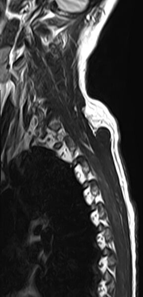 File:Cervical compressive myelopathy (Radiopaedia 71956-82411 Sagittal T2 1).jpg