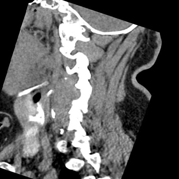 File:Cervical spinal neurofibroma in a patient with NF1 (Radiopaedia 58344-65464 C 16).jpg