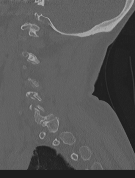 File:Cervical spondylolysis (Radiopaedia 49616-54811 Sagittal bone window 54).png