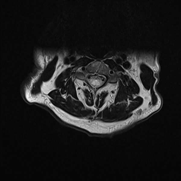 File:Cervical tumor-like myelopathy due to Type V dAVF (Radiopaedia 82461-96604 Axial T2 13).jpg