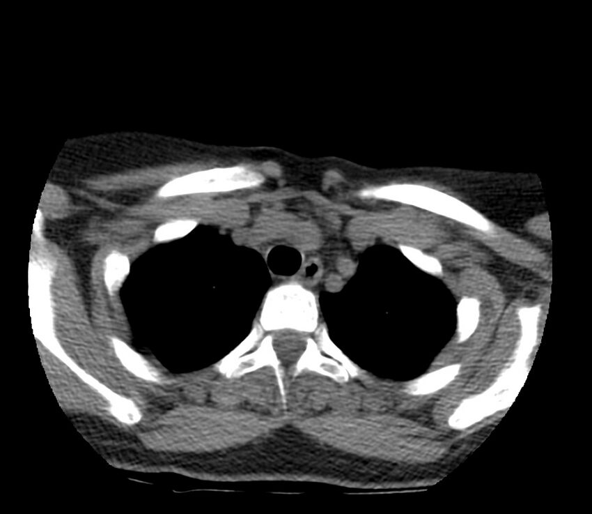 Cervical venous malformation (Radiopaedia 22653-22672 Axial non-contrast 53).jpg