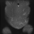 Cesarian section scar endometriosis (Radiopaedia 66520-75799 Coronal STIR 1).jpg